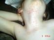 Molluscum on chin of 6 year old
